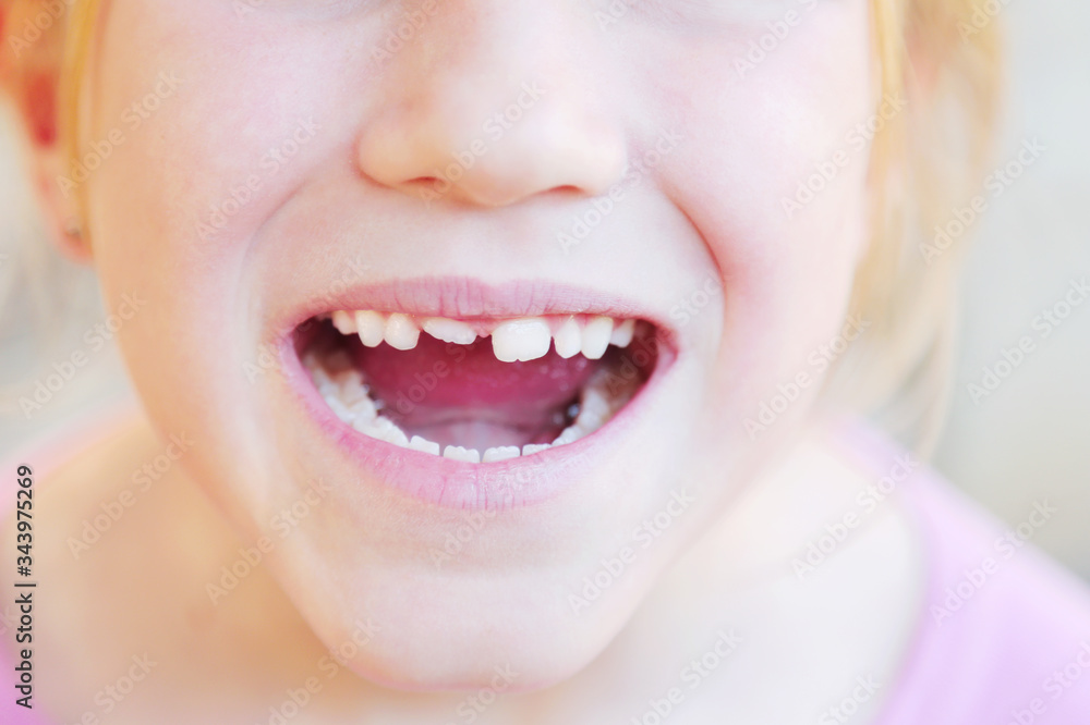 Kid with crooked teeth. Girl show her diastema teeth. Kid with crooked teeth. Girl show her diastema teeth.
