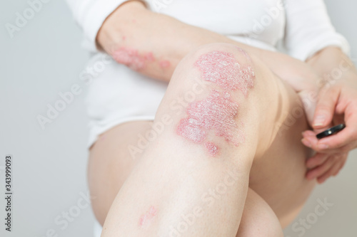 Acute psoriasis on the knees ,body ,elbows is an autoimmune incurable dermatological skin disease. Large red, inflamed, flaky rash on the knees. Joints affected by psoriatic arthritis. © SNAB
