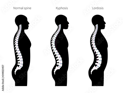 Kyphosis, lordosis flat vector illustration. 