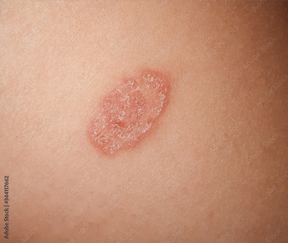 Fototapeta premium lichen on a person's buttock