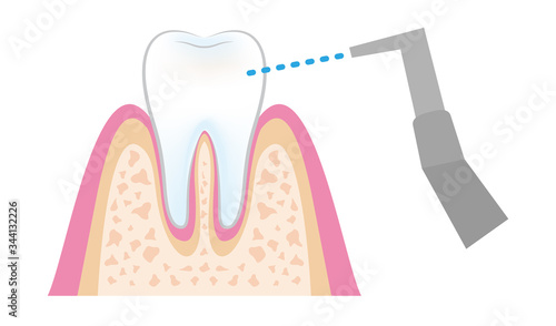 dental_pmtc_step08