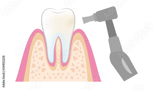 dental_pmtc_step07