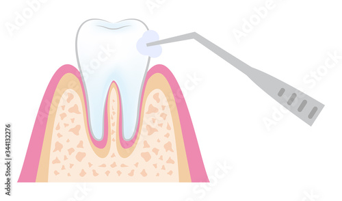 dental_pmtc_step09