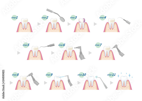 dental_pmtc_step1-11