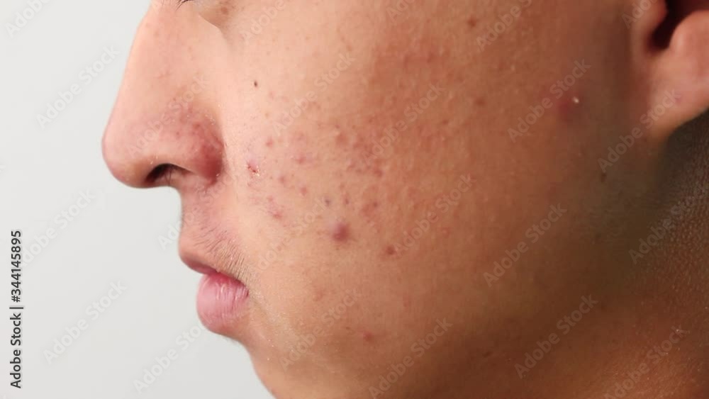 Close-up the side face of Asian teenage guy with acne and skin problems. Health and skin care concepts. Close-up the side face of Asian teenage guy with acne and skin problems. Health and skin care concepts.
