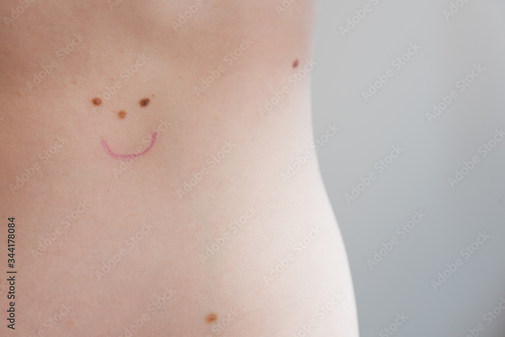 Moles on the skin with a painted smile. The concept of a healthy body and skin. Checking the skin in the clinic. Moles on the skin with a painted smile. The concept of a healthy body and skin. Checking the skin in the clinic.