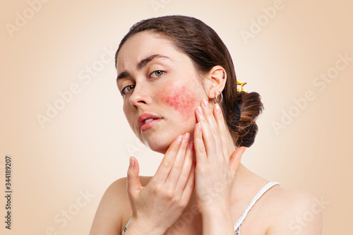 Obraz na plátně Portrait of a young pretty Caucasian woman who frowns and shows reddened and inflamed cheeks
