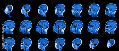 set of serial MRI scans of sixty years old caucasian female head in sagittal or longitudinal plane photo