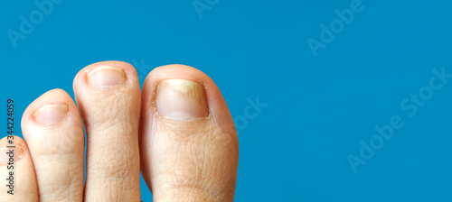 Εκτύπωση καμβά panoramic images of toe with nail psoriasis
