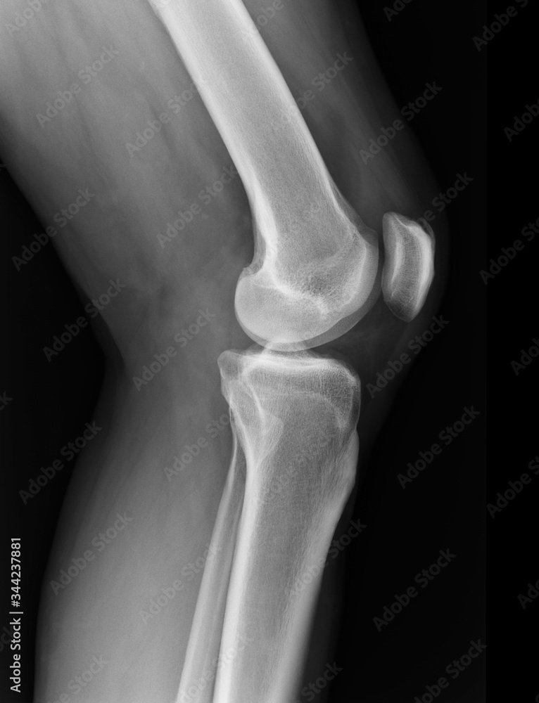 X-ray knee radiograph show state of injury X-ray knee radiograph show state of injury