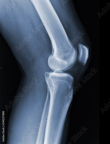 X-ray knee radiograph show state of injury