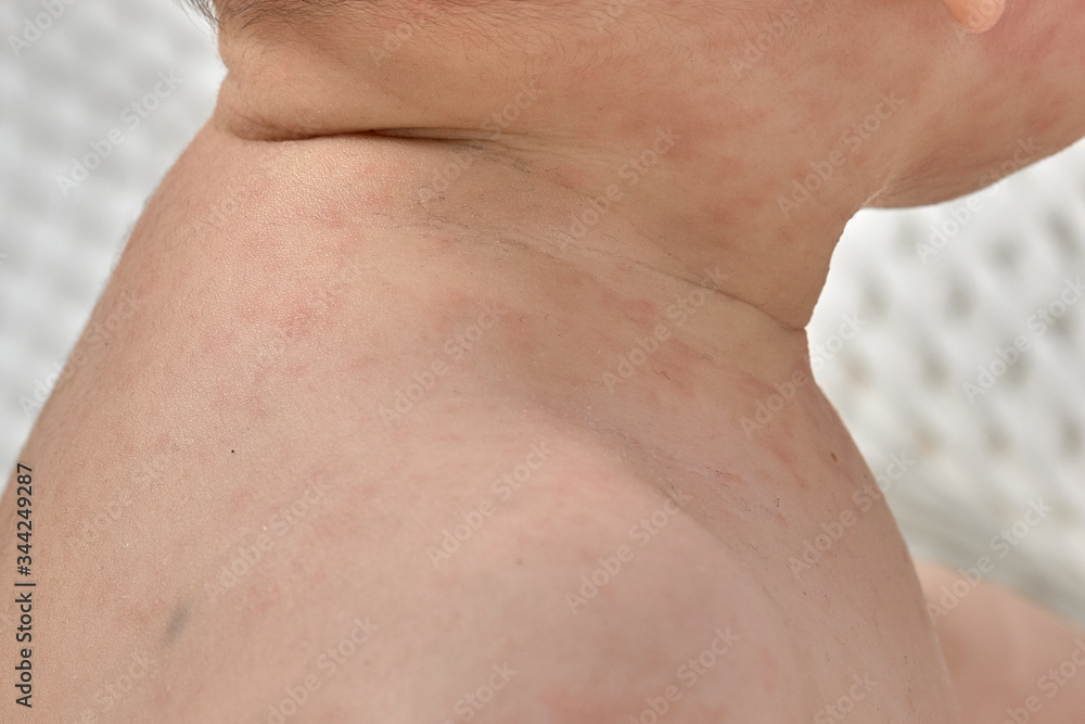 roseola rash a viral rash on the skin of a child Stock Photo | Adobe Stock