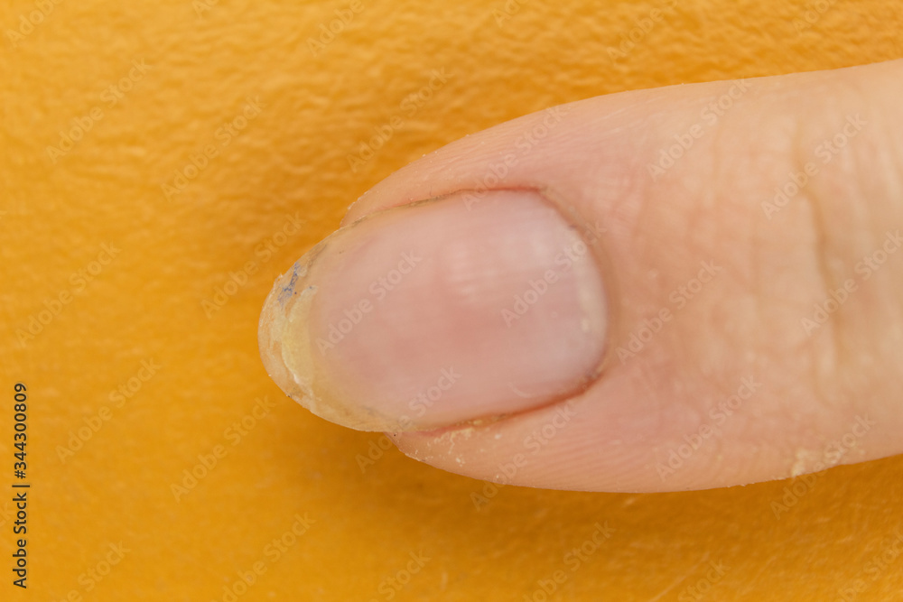 Onychomycosis of a nail disease in which the nails exfoliate Onychomycosis of a nail disease in which the nails exfoliate