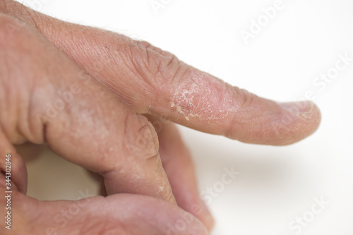 Trockene Haut, Mittelfinger, links, Detail © casi