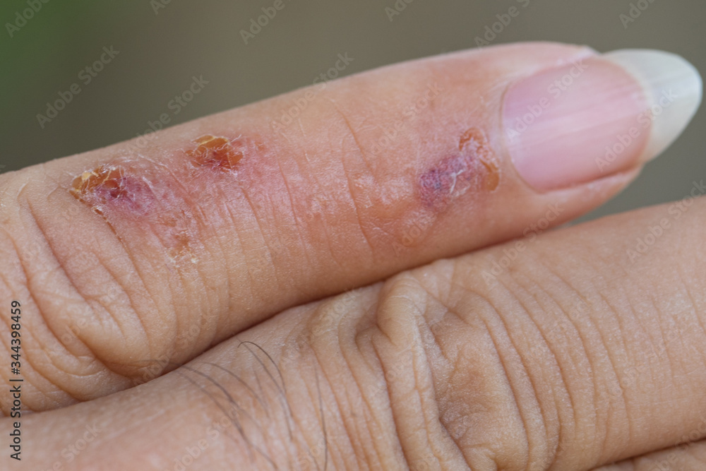 Skin disease caused by allergies around the little finger. Skin disease caused by allergies around the little finger.