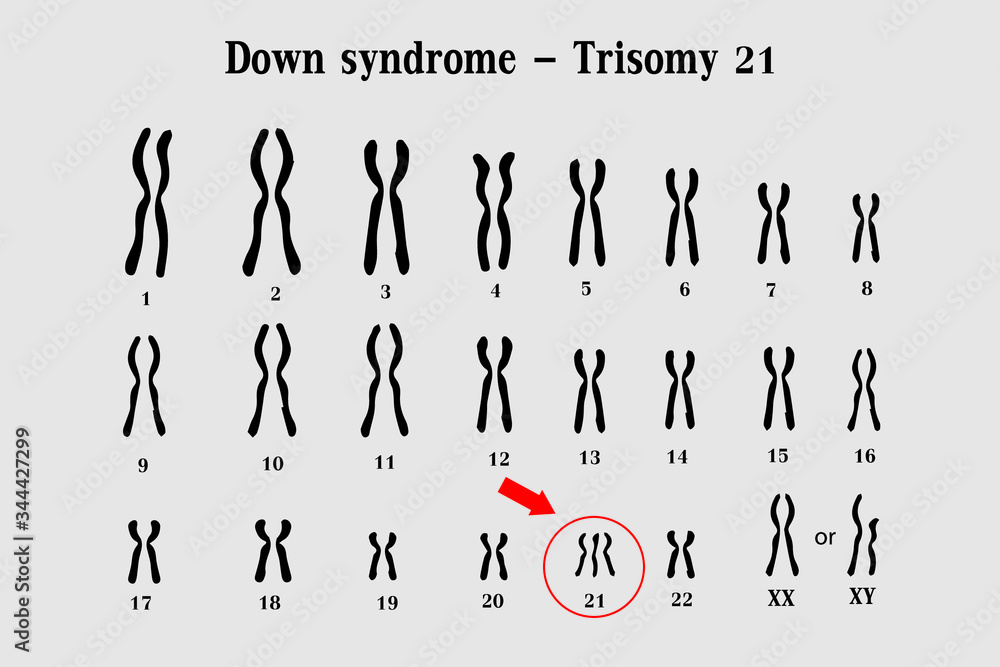 Karyotype Of Down Syndrome DS Or DNS Also Known As Trisomy 21 Is A 