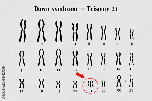 Karyotype of Down syndrome (DS or DNS), also known as trisomy 21, is a genetic disorder caused by the presence of all or part of a third copy of chromosome 21 photo