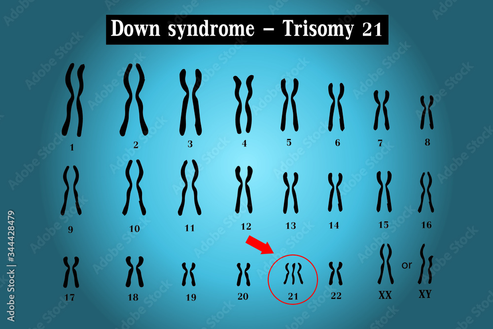 Karyotype of Down syndrome (DS or DNS), also known as trisomy 21, is a disorder caused