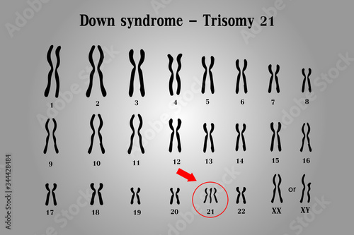 Karyotype of Down syndrome (DS or DNS), also known as trisomy 21, is a genetic disorder caused by the presence of all or part of a third copy of chromosome 21