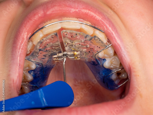 Dentist check up teeth with expander brackets