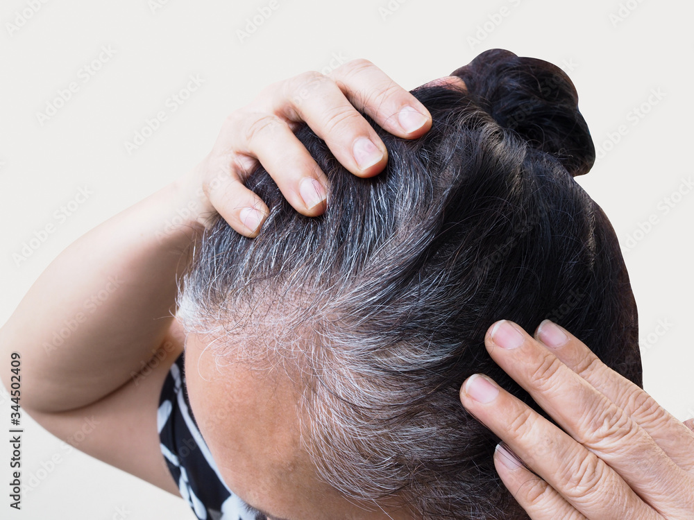 Fototapeta premium Hair health problems with hair loss, thinning hair