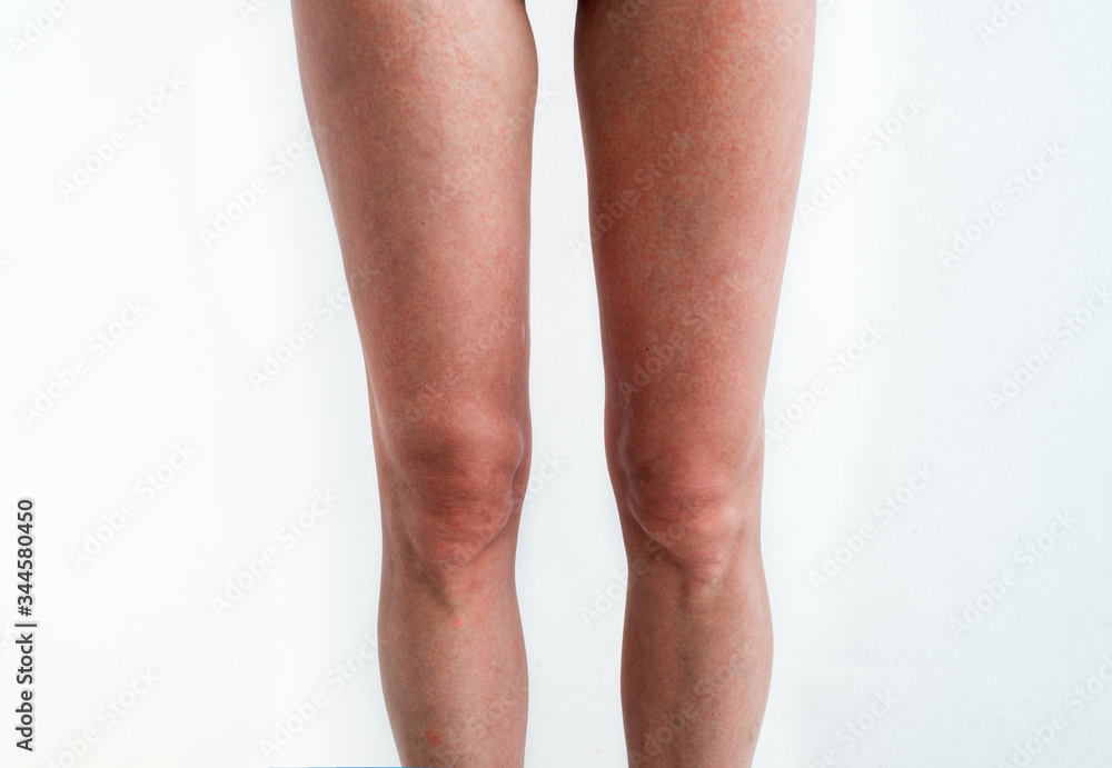 Severe sunburn, summer tan, poor sun protection. Sun allergies