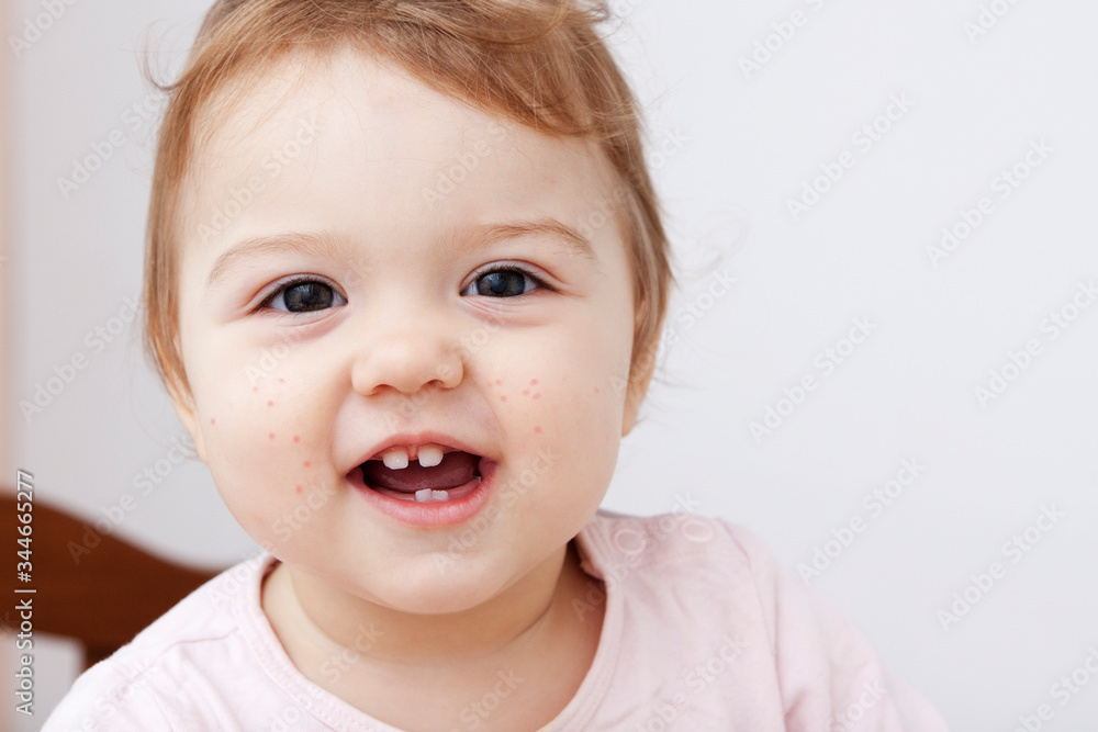 A baby with a small rash on her cheeks