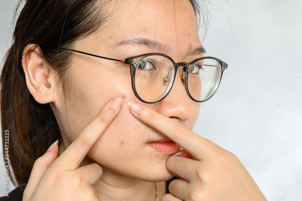 Portrait of Asian woman trying to squeeze acne on her face. Conceptual shot of problems with acne and scar on the female skin. Portrait of Asian woman trying to squeeze acne on her face. Conceptual shot of problems with acne and scar on the female skin.