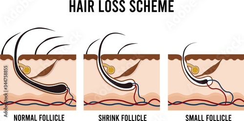 HAIR LOSS SCHEME - NORMAL, SHRINK, SMALL FOLLICLE