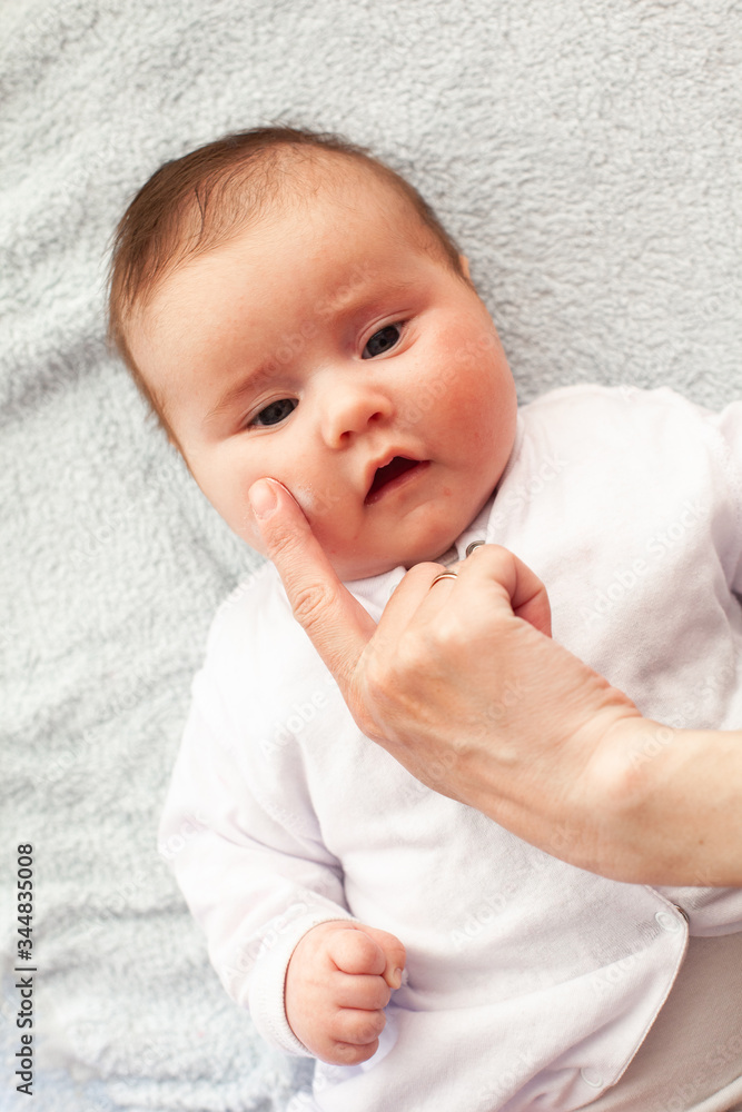 Baby with atopic dermatitis getting cream put. Care and Prevention Of Eczema. Baby with atopic dermatitis getting cream put. Care and Prevention Of Eczema.