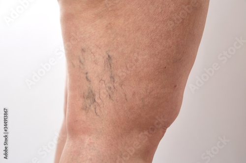 legs of a 40-year-old woman with stretch marks, cellulite and varicose veins close-up photo