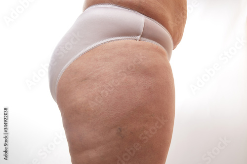 legs and buttocks of a 40-year-old woman with stretch marks, cellulite and varicose veins on a white isolated background photo