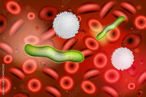 
Sepsis (Blood Infection). Etiologic Agents of Bacterial Sepsis. Sepsis is an inflammatory immune response triggered by an infection.