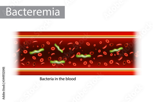 Bacteremia (also bacteraemia) is the presence of bacteria in the blood.