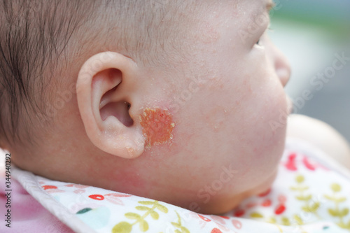 Close-up on  Inflamed Skin  on Newborn Baby Face photo