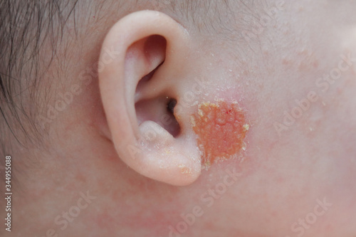Close-up on  Inflamed Skin  on Newborn Baby Face photo