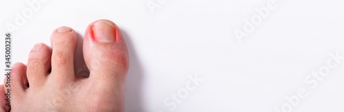 Photos Close-up Of Sore Toe Nail