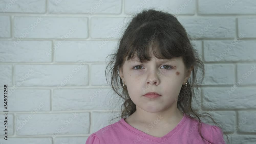 A child with a lollipop. A sad little girl with wounds on her face is given a candy. A child with a lollipop. A sad little girl with wounds on her face is given a candy.