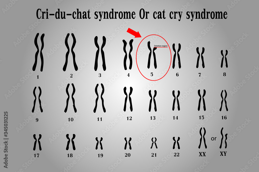 Cri du chat syndrome , also known as 5p- (5p minus) syndrome or cat cry syndrome, deletion of genetic material on the small arm (the p arm) of chromosome5.Genetic syndromes mentioned Cri du chat syndrome , also known as 5p- (5p minus) syndrome or cat cry syndrome, deletion of genetic material on the small arm (the p arm) of chromosome5.Genetic syndromes mentioned