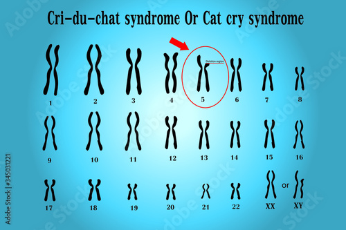 Cri du chat syndrome , also known as 5p- (5p minus) syndrome or cat cry syndrome, deletion of genetic material on the small arm (the p arm) of chromosome5.Genetic syndromes mentioned