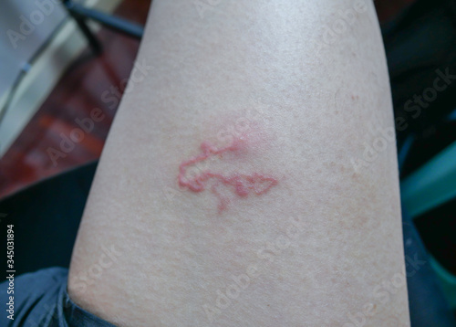 Creeping eruption or Cutaneous larva migrant on the leg, disease in tropical forest zone