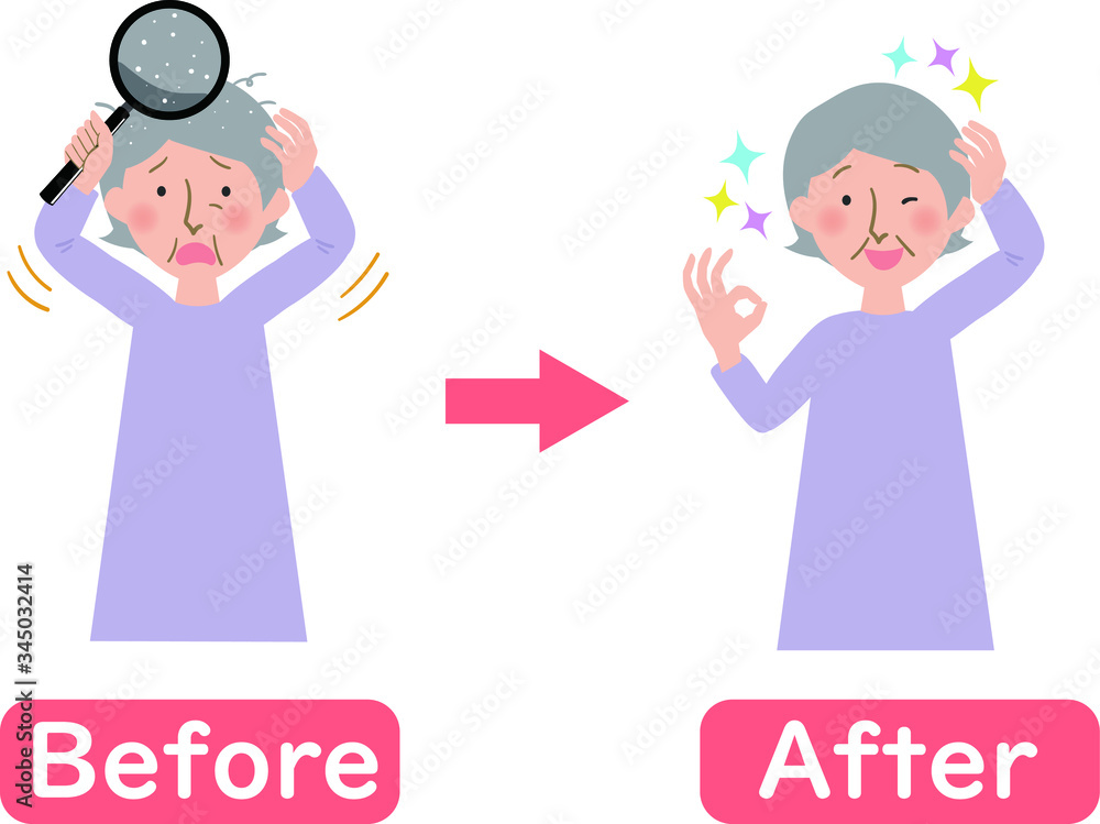 頭皮のフケに悩むおばあちゃんのビフォーアフターベクターイラスト Stock Vector Adobe Stock