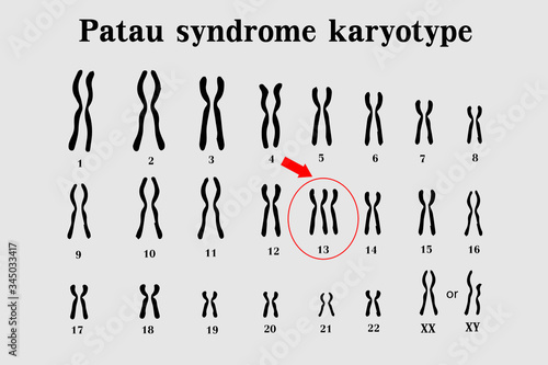 Patau syndrome karyotype is the one of chromosomal disorders that have extra copy of chromosome 13