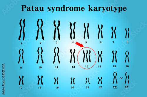 Patau syndrome karyotype is the one of chromosomal disorders that have extra copy of chromosome 13