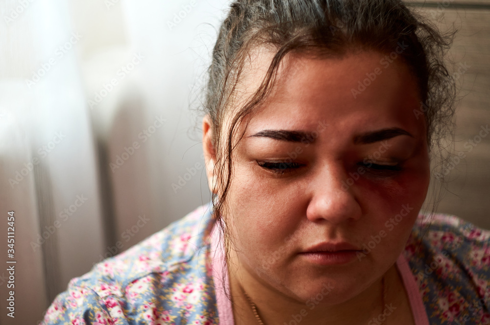 Woman with bruise on face sadly looking, bruised face close-up Woman with bruise on face sadly looking, bruised face close-up