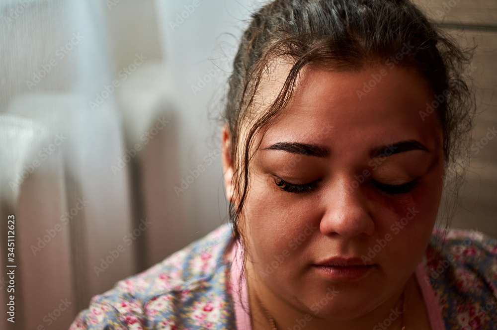Woman with bruise on face sadly looking, bruised face close-up Woman with bruise on face sadly looking, bruised face close-up