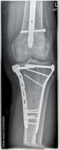 Radiographs, x-rays of a heavily injured motorcyclist with multiple fractures and implants.