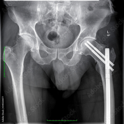 Radiographs, x-rays of a heavily injured motorcyclist with multiple fractures and implants.