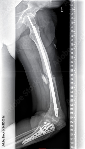Radiographs, x-rays of a heavily injured motorcyclist with multiple fractures and implants.