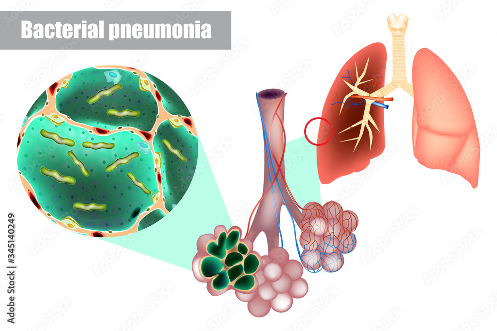 Bacteria inside alveoli of lung. Bacterial pneumonia (bacterial infection). Pneumococcal disease